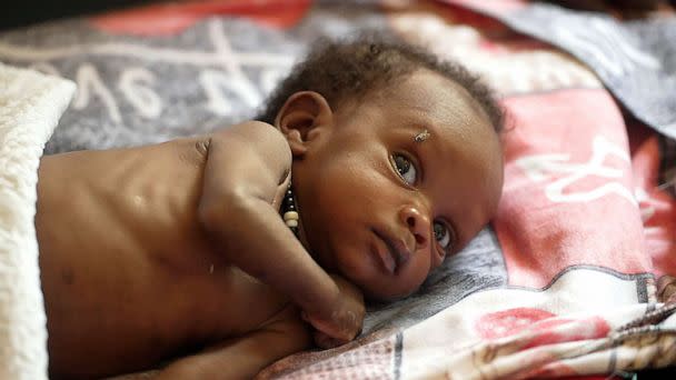 PHOTO: One in five children in South Sudan are severely malnourished. (Jimmy Gillings/ABC News)