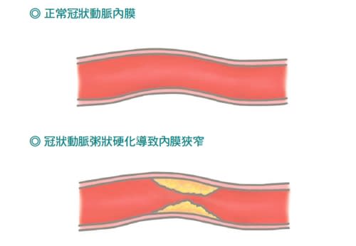 心肌梗塞