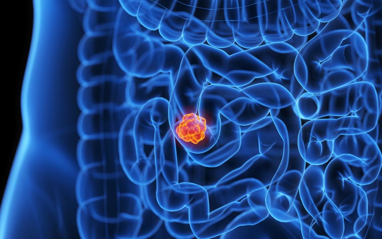 Intestine tumour, illustration