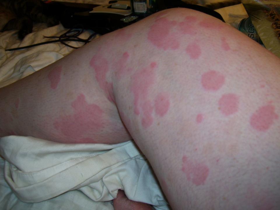 hives urticaria identification picture