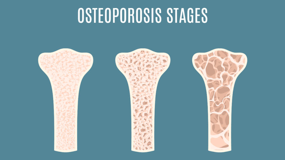 An illustration of osteoporosis stages