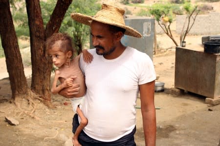 Ali Muhammad, father of malnourished Muath Ali Muhammad, holds him near their home in Aslam district of the northwestern province of Hajja