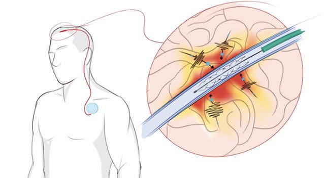 The electrode translates brain messages. Picture: Royal Melbourne Hospital