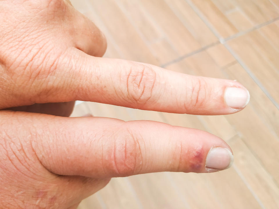 Swollen finger due to a wasp sting