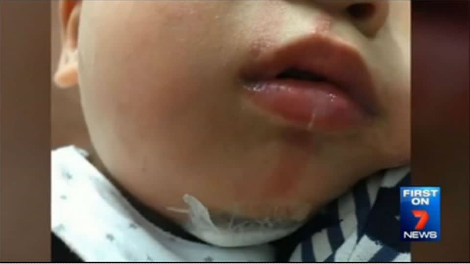 The burns suffered by 15-month-old Leon after he drank water from a cup at childcare. Photo: 7News