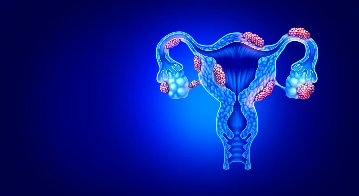 Endometriosis disease anatomy concept of female infertility condition as uterus avaries and fallopian tubes with tissue growth with 3D illustration elements.