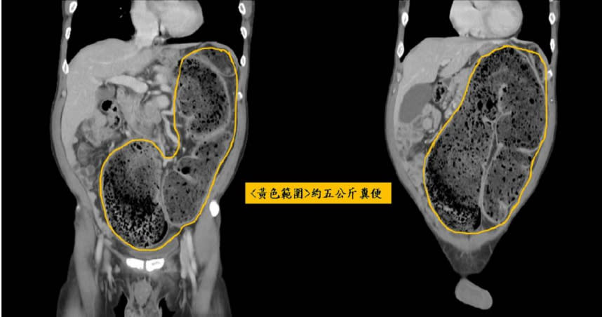 病患宿便向上頂到心臟。（圖／翻攝自臉書／中國醫藥大學新竹附設醫院）