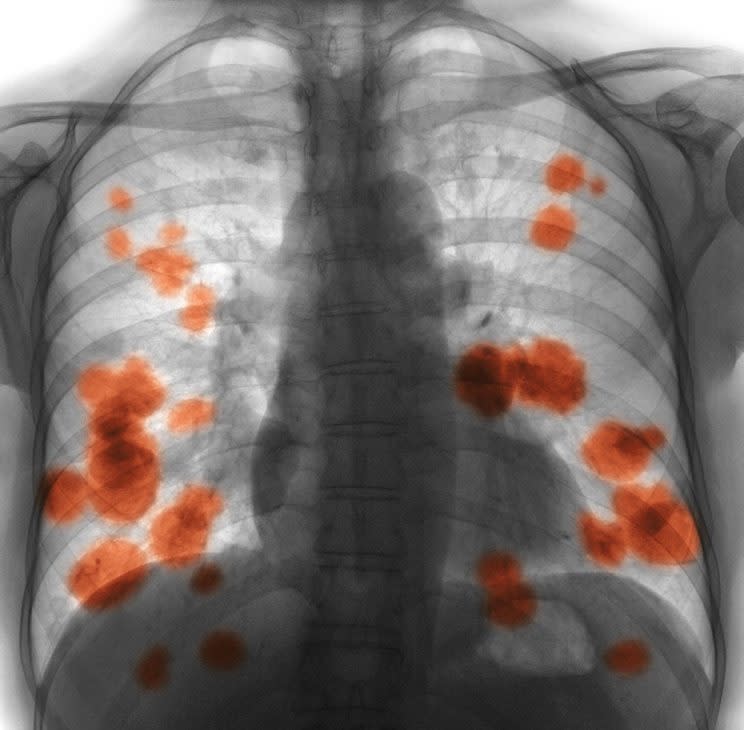 A blood test has been developed that may allow doctors to spot signs of lung cancer up to five years before it shows up on traditional scans.