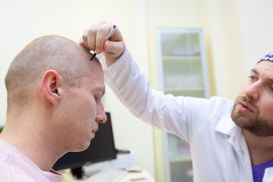 a hair transplant surgeon outlining a man's new hairline