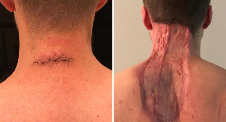 Perth dad Ryan Glossop with small wound after mole removal and a giant chunk of his neck and back missing.