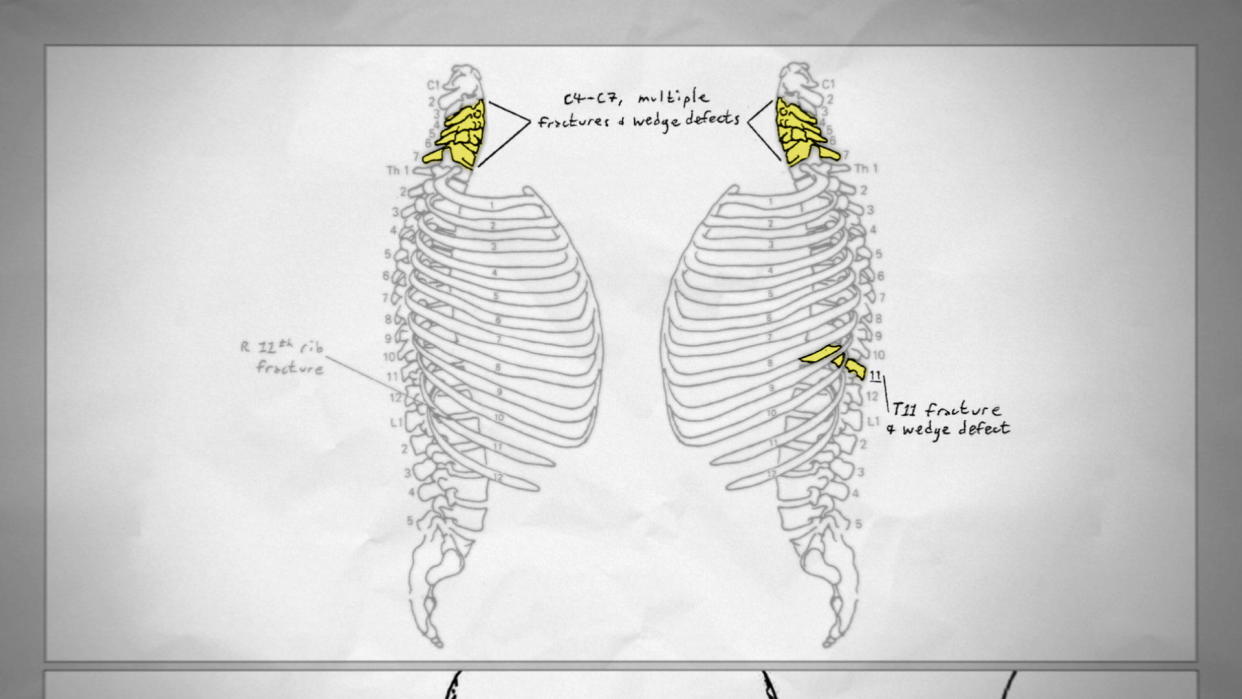 Dr. James Feig testified that Andreen's skeletal remains had severe injuries consistent with being struck by a blunt object. She had a fractured spinal cord, a broken rib and a split jaw. 