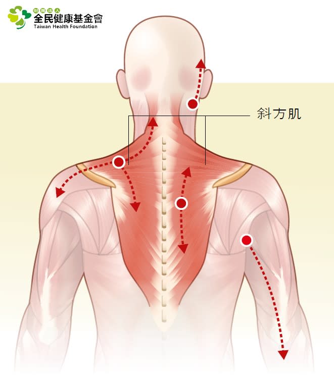 斜方肌筋膜疼痛症候群