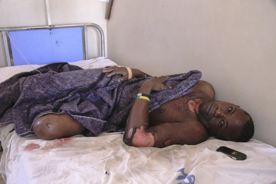 CORRECTING TO PETROL TANKER - An injured person in hospital after a petrol tanker exploded, Saturday, Aug. 10 2019, in Morogoro, Tanzania.  A damaged tanker truck exploded in eastern Tanzania Saturday as people were trying to siphon fuel out of it, killing at least 62, in one of the worst incidents of its kind in the East African country. (AP Photo)