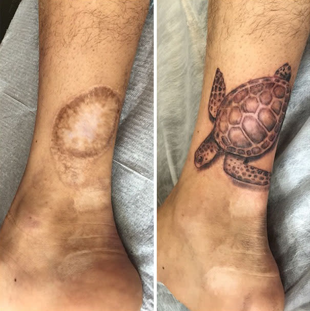 Tatuajes sobre cicatrices