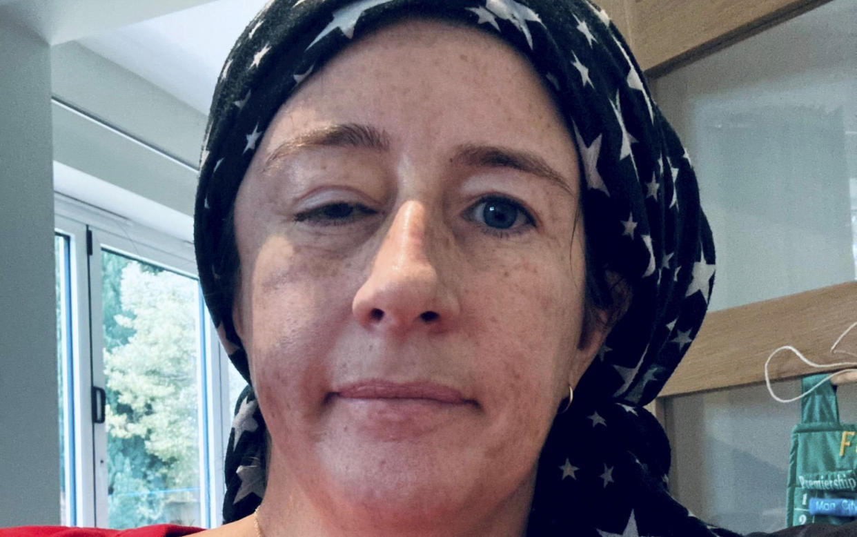 Kirsty Drury mistook her bloodshot eye for conjunctivitis but it was actually a symptom of a brain tumour, pictured seven days post surgery. (SWNS)