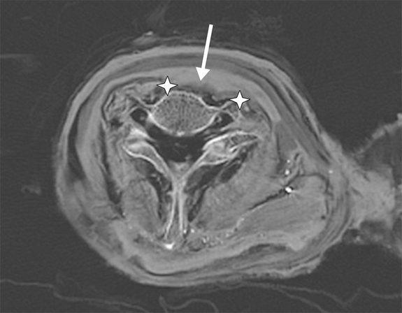 To solve this mummy murder mystery, researchers conducted computed tomography (CT) scans on Ramesses III's mummy, finding wounds in his neck (stars). (Arrow points to embalming material seeping into the wound and bone.)