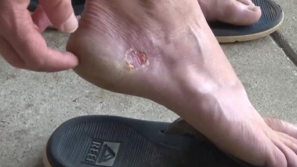 Brent Norman’s feet swelled after coming into contact with the flesh-eating bug (WCIV)