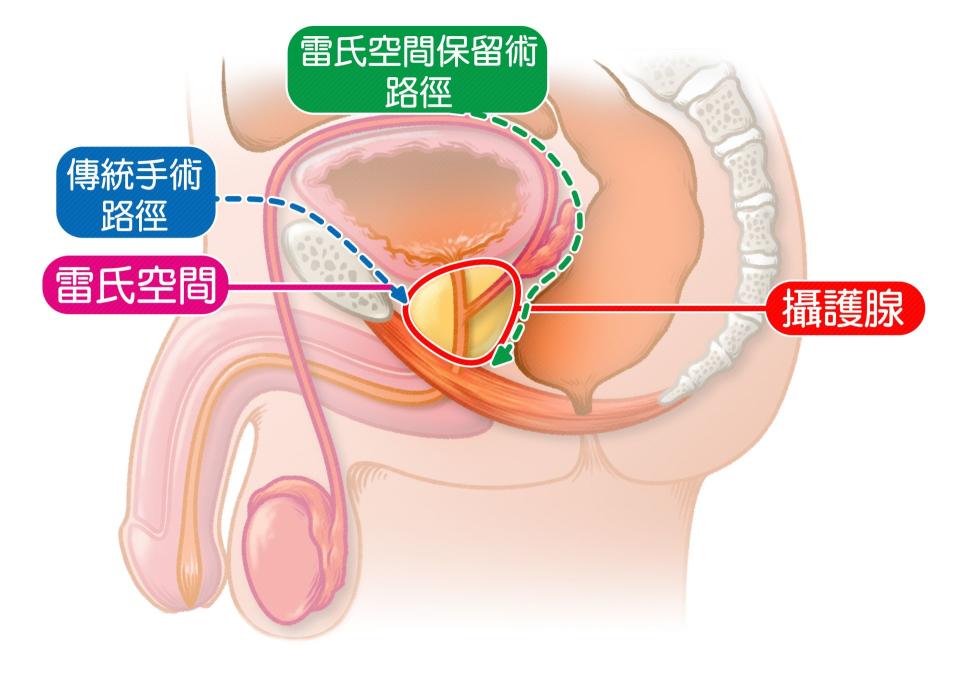 雷氏空間保留術（綠色）改善攝護腺切除手術後漏尿與性功能障礙問題，提升病人生活品質。