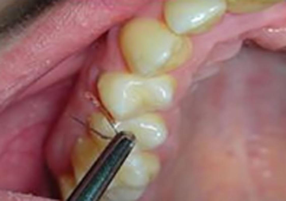 Inside a woman's mouth where a pair of tweezers removes a hair from between her gums.