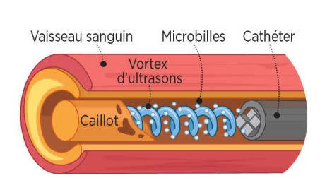 En projetant les ondes ultrasonores en tourbillon, la sonothrombolyse se révèle plus rapide. Crédit : BRUNO BOURGEOIS