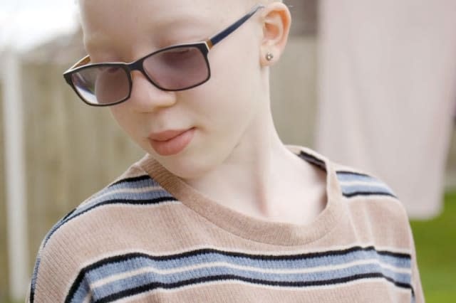 A British teenager with albinism is following her dreams of becoming a model