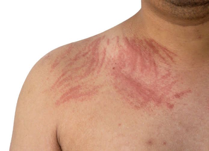 The image shows the bare shoulder and upper chest of a person with visible red skin irritation and inflammation