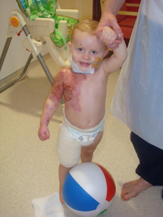 Charlie underwent nine years of physiotherapy after suffering burns from boiling water as a baby (Collect/PA Real Life)