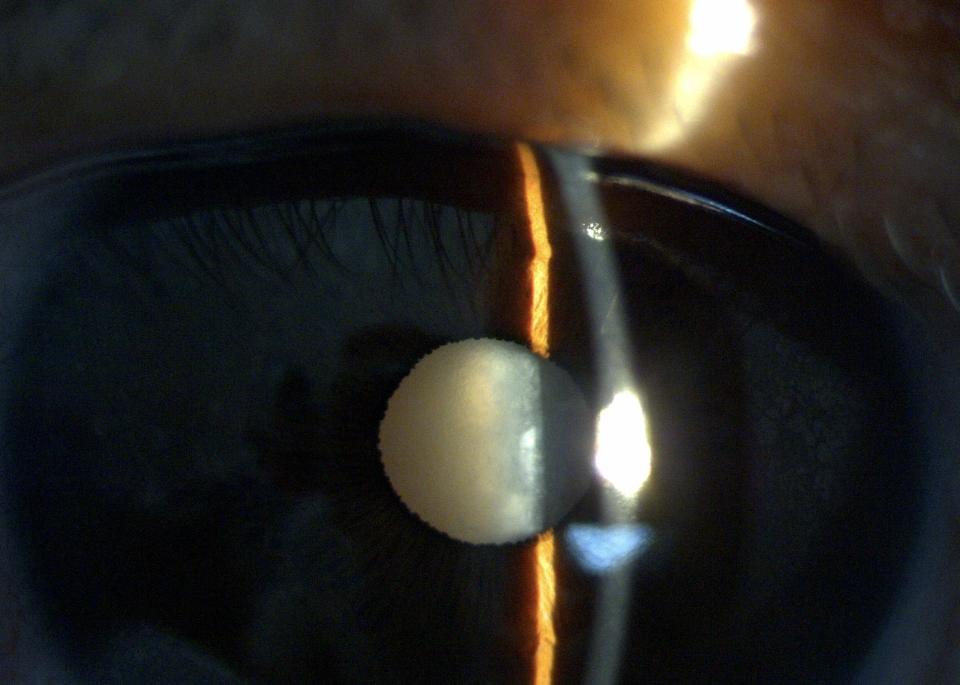 圖：諾貝爾眼科集團提供