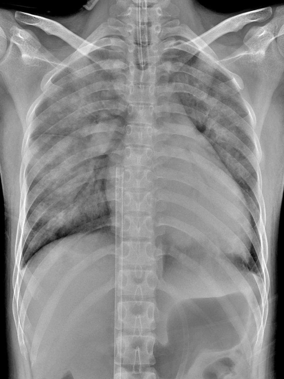 <strong>鄭小姐裝上葉克膜六小時後，胸腔X光影像中肺部幾乎呈白色，肺水腫嚴重且心臟明顯擴大。（圖／花蓮慈濟醫院提供）</strong>