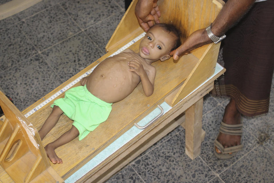 In this Sunday, June 14, 2020 photo, seven-month-old Issa Ibrahim Nasser is measured at a clinic in Deir Al-Hassi, At seven months old, Issa weighs only three kilos. Like him, hundreds of children suffer from acute severe malnutrition because of poverty and grinding conflict. Yemen. (AP Photo/Issa Al-Rajhi)