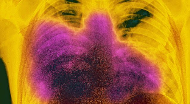 X-rays of a patient diagnosed with pneumonia. Source: Getty Images