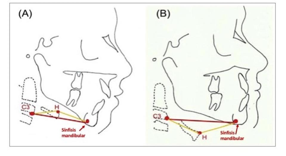 Figura 2. A. Respirador habitual por la boca. Posición elevada del hueso hioides (H) con respecto a la línea formada por la 3ª vértebra cervical (C3) la parte más posterior de la sínfisis mandibular, leve cresta donde se unen las dos piezas de la mandíbula. B. Respirador habitual por la nariz. El hueso hioides está por debajo de la línea que forma C3 y la sínfisis mandibular. Fuente original: Chung and Beltri , 2014.