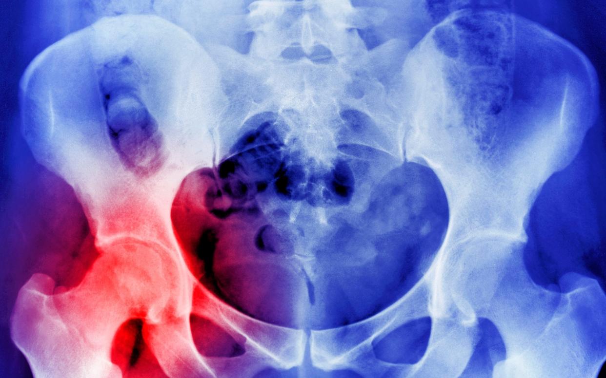 Osteoporosis leads to broken bones and frailty, but the new nanokick technology coaxes stem cells into bone  - Photographer's Choice