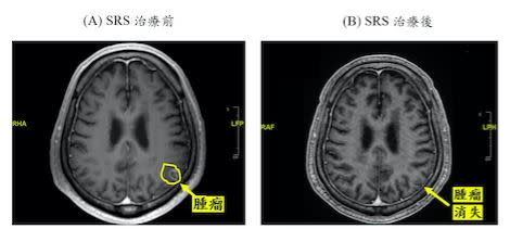 陳先生左腦頂葉出現一個1.3公分的轉移性腫瘤。（圖／亞東醫院提供）