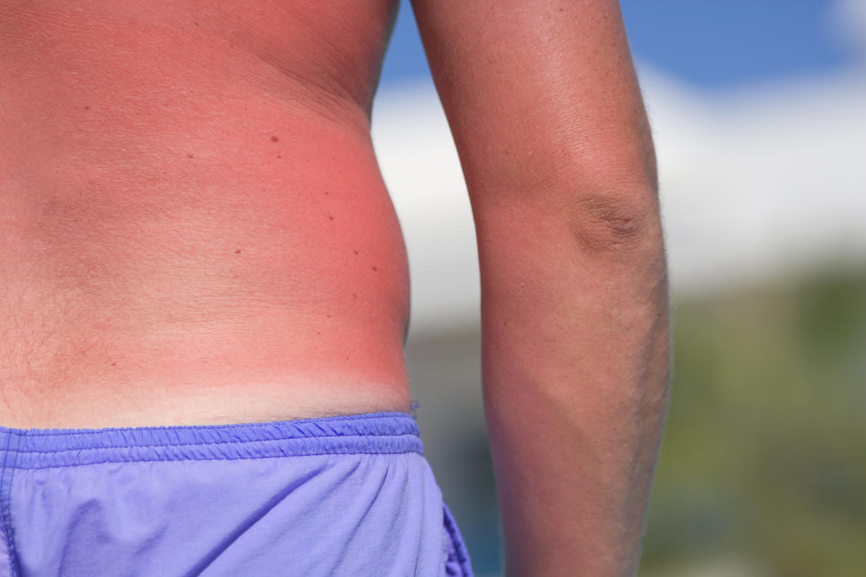 Man with extreme sunburn on his torso