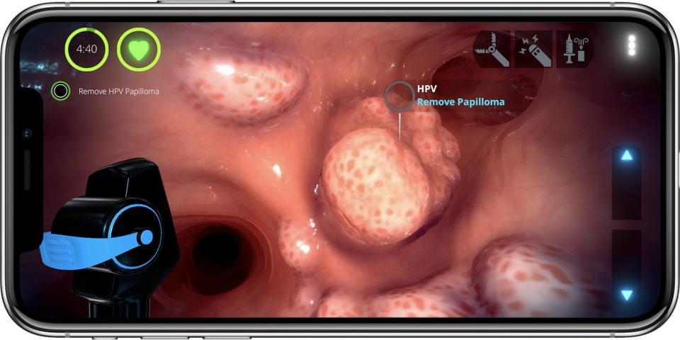 A player needs to remove a papilloma this case inside Level Ex's Pulm Ex game.