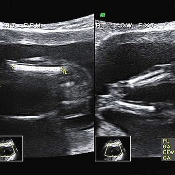 We've partnered with the American Institute of Ultrasound Medicine (AIUM), Johns Hopkins, and the March of Dimes to create this unique peak into Baby's development inside the womb. These images reveal all the intricate details of your baby's growth -- from a collection of cells to a full-term newborn. While most women may only receive one or two ultrasounds during pregnancy, which is normal, this slideshow of the 2nd trimester of pregnancy gives you a look at each week of development.