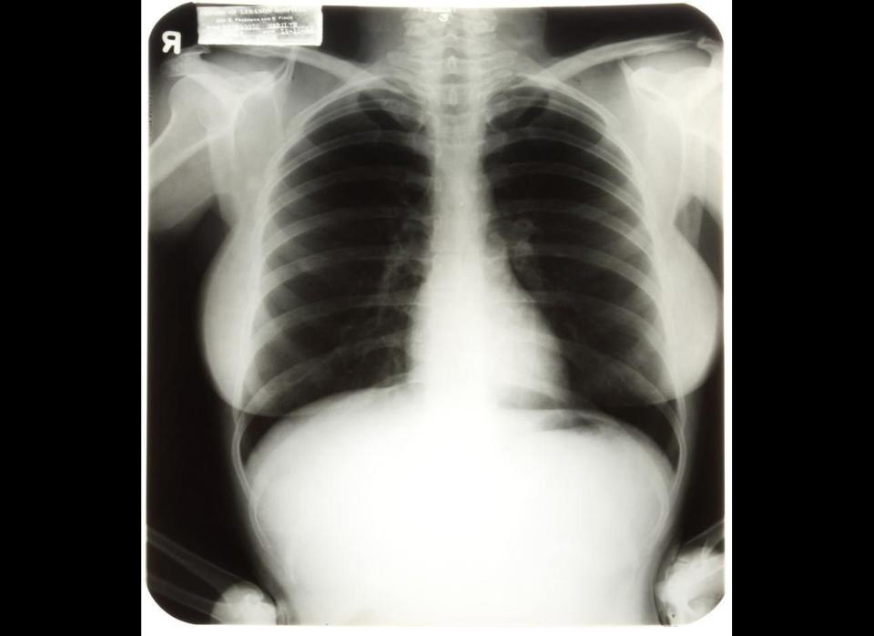 Three X-rays of Marilyn Monroe's chest and pelvis taken during a 1954 hospital visit have sold for more than 10 times their presale estimates, earning $45,000. 