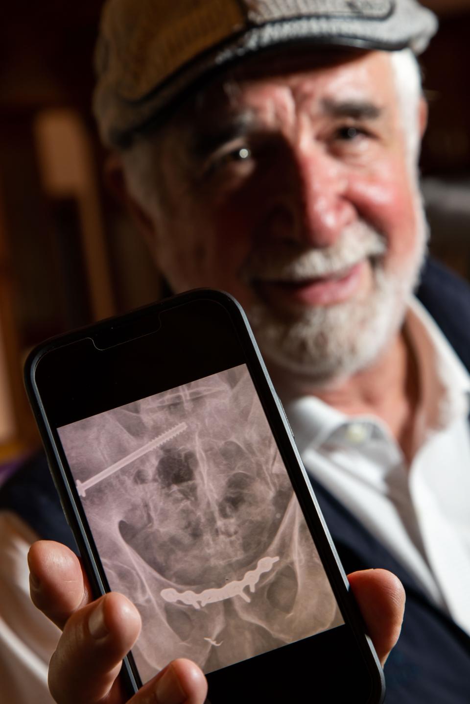 Tom Equels shows the X-ray of his pelvis after surgery.