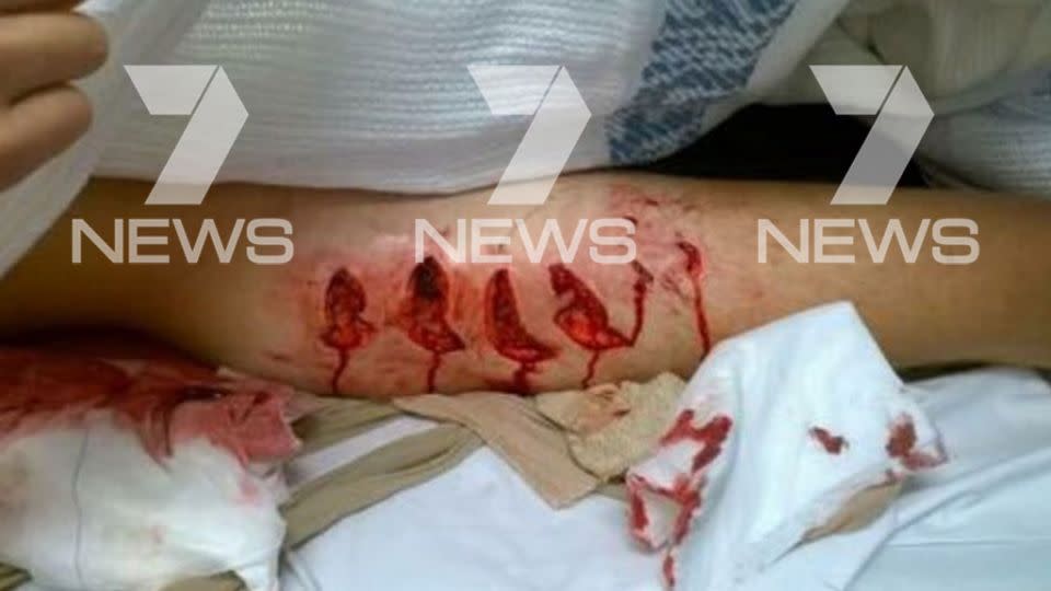 Cooper Allen was left with bloodied chunks of flesh missing from his leg. Photo: 7 News