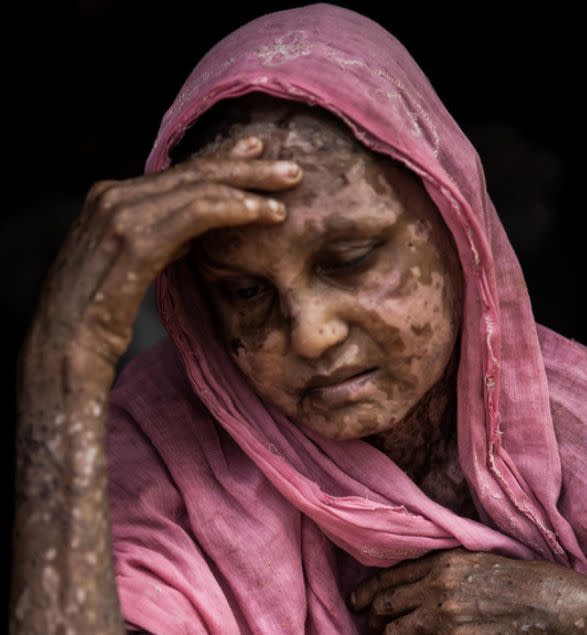 Shara Jahan,&nbsp;sitting for a portrait in&nbsp;Bangladesh's Kutupalong&nbsp;Refugee Camp, was badly burned before she fled Myanmar. (Photo: Andrew Stanbridge/Amnesty International)