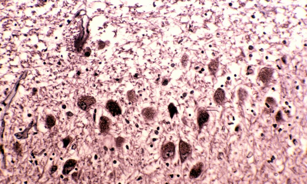 Neurofibrillary tangles in the cerebellum of the brain of a person with Alzheimer’s disease.