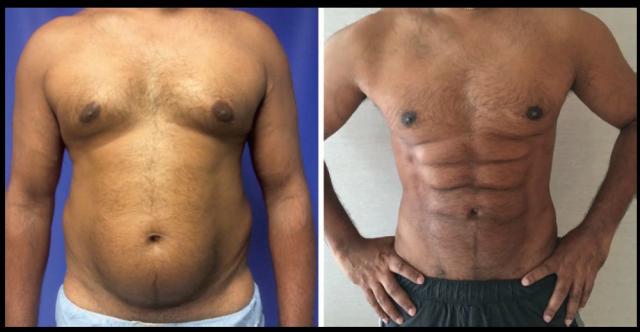 3 Cosmetic Procedures That Give You Six-Pack Abs