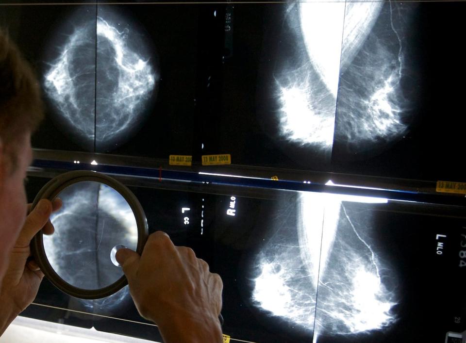 A radiologist uses a magnifying glass to check mammograms for breast cancer. An Ottawa doctor says more awareness campaigns and screening programs are needed to get risk factors on the minds of young women. (Damian Dovarganes/The Associated Press - image credit)