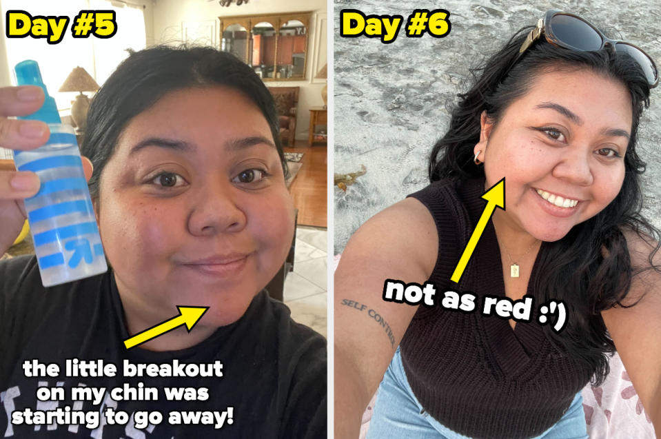 The author is showing her skin on day five and day six of using rice water, saying "The little breakout on my chin was starting to go away"