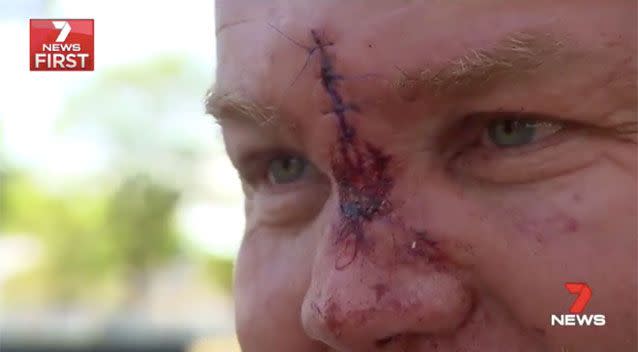 Paul received stitches after allegedly being head butted. Source: 7 News