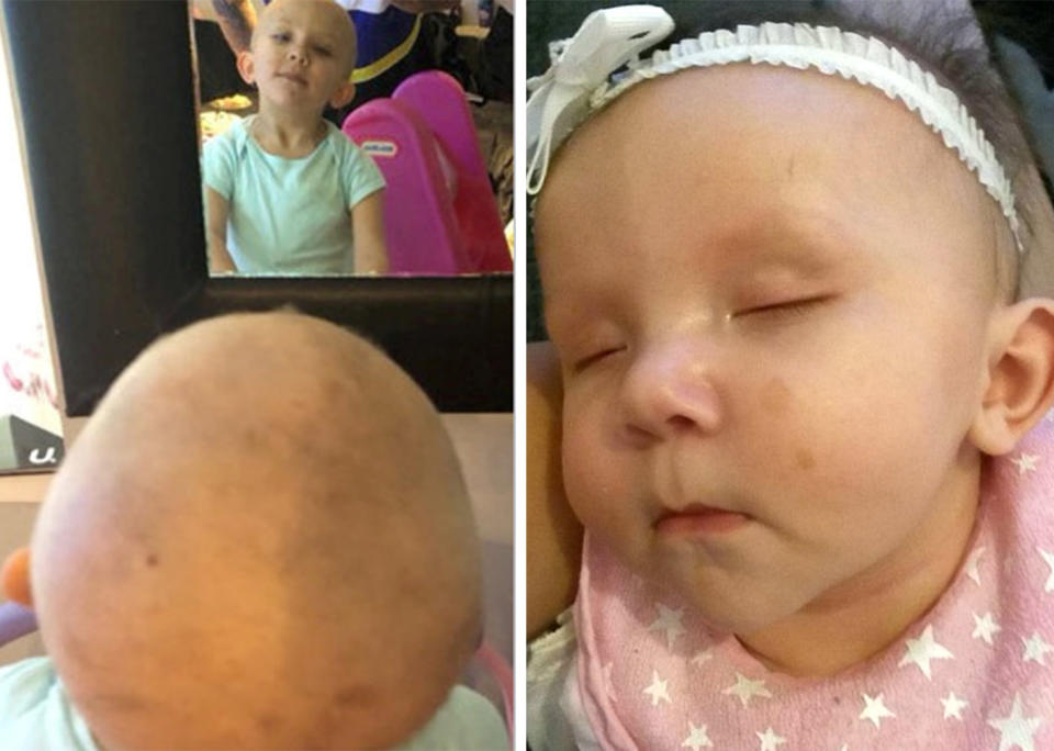 Ruby Galloway was born with small dark spots on her cheeks, head and chest. Her parents initially thought they were just freckles or birthmarks. Source: MEGA