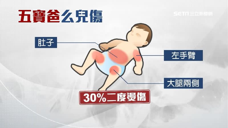 五寶媽幫7個月大的么兒洗澡時疑似分心，造成他全身百分之30二度燙傷。