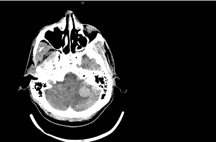 Williams' CT scan