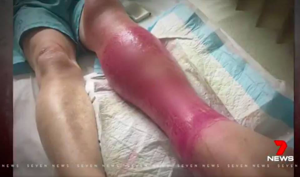 The flesh-eating disease ate away most of Tom’s lower leg. Source: 7 News